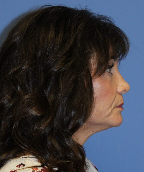 Facelift #6410 – click HERE for more views before photo. Individual results may vary.
