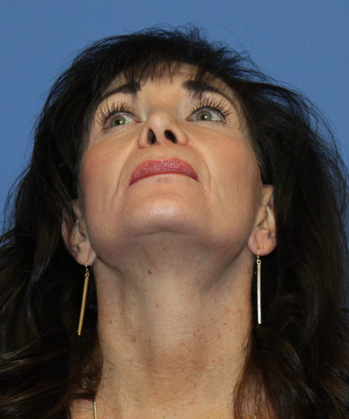 Rhinoplasty #6421 – click HERE for more views before photo. Individual results may vary.