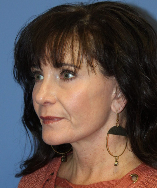 Rhinoplasty #6421 – click HERE for more views after photo. Individual results may vary.
