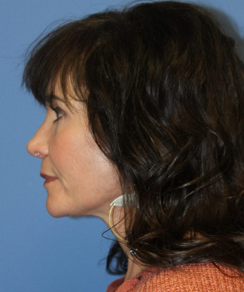 Rhinoplasty #6421 – click HERE for more views after photo. Individual results may vary.