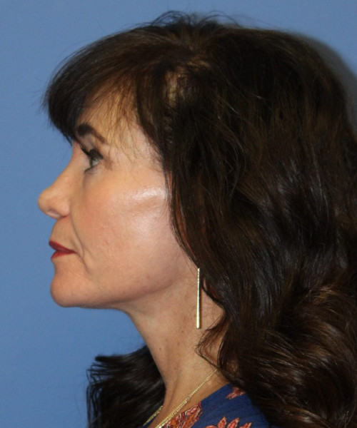 Rhinoplasty #6421 – click HERE for more views before photo. Individual results may vary.