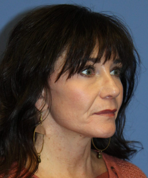 Rhinoplasty #6421 – click HERE for more views after photo. Individual results may vary.