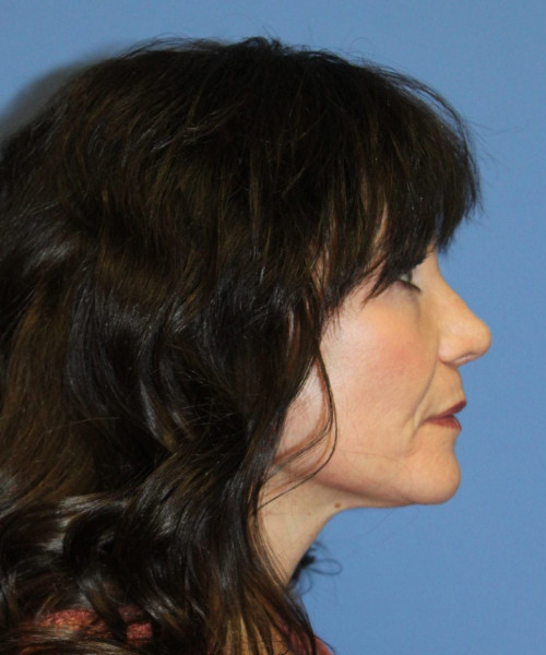 Rhinoplasty #6421 – click HERE for more views after photo. Individual results may vary.