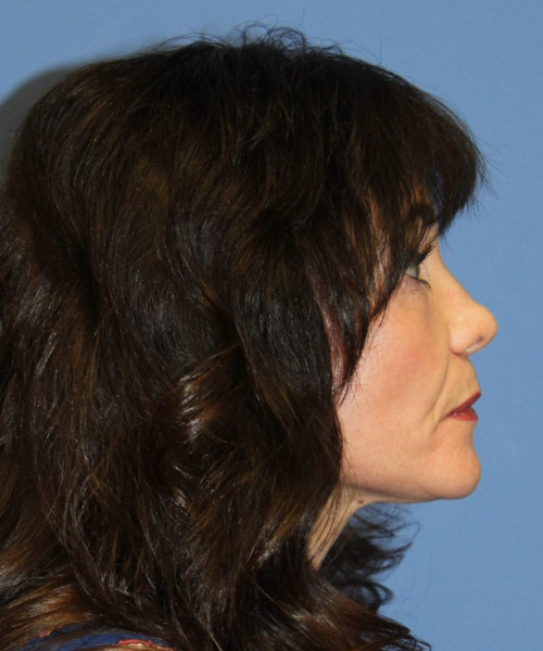 Rhinoplasty #6421 – click HERE for more views before photo. Individual results may vary.