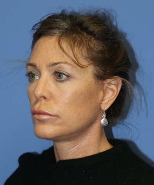 Facelift #6475 – click HERE for more views after photo. Individual results may vary.