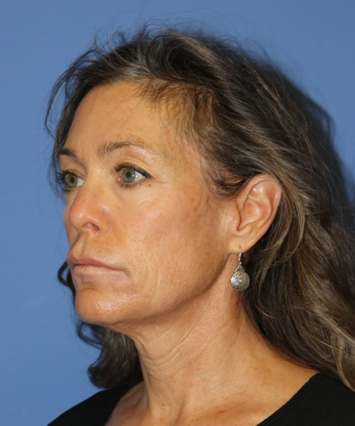 Facelift #6475 – click HERE for more views before photo. Individual results may vary.