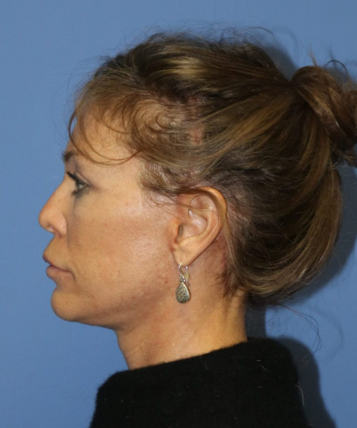Facelift #6475 – click HERE for more views after photo. Individual results may vary.