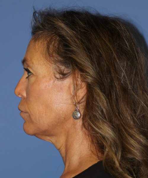 Facelift #6475 – click HERE for more views before photo. Individual results may vary.