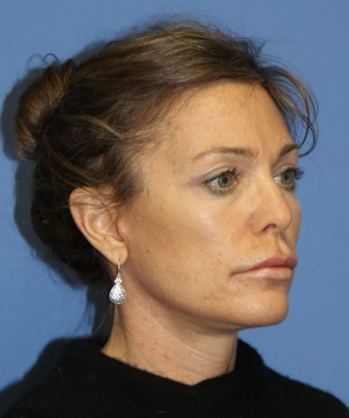 Facelift #6475 – click HERE for more views after photo. Individual results may vary.