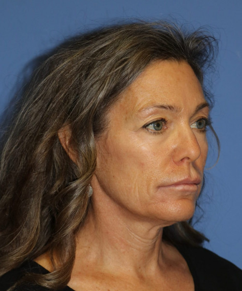 Facelift #6475 – click HERE for more views before photo. Individual results may vary.