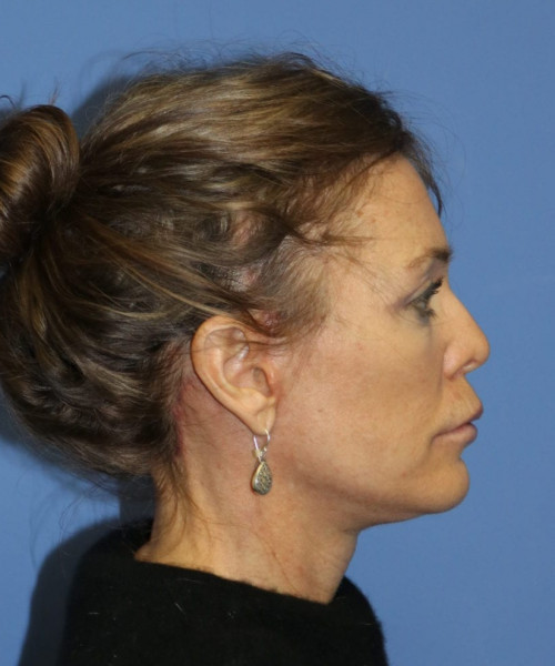 Facelift #6475 – click HERE for more views after photo. Individual results may vary.