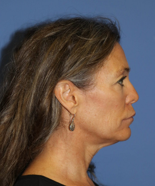 Facelift #6475 – click HERE for more views before photo. Individual results may vary.