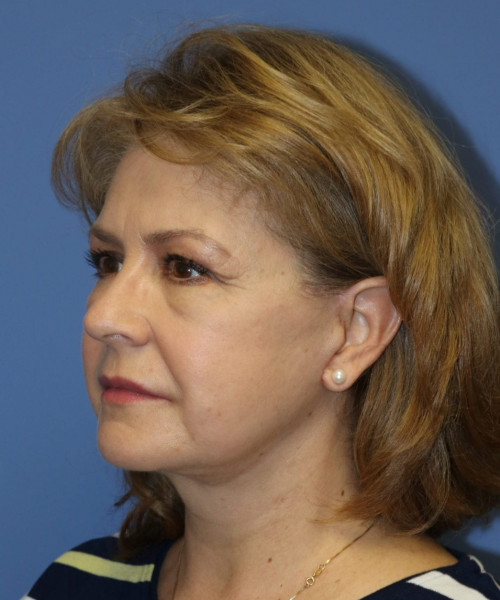 Facelift #6486 – click HERE for more views after photo. Individual results may vary.