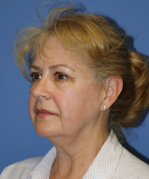Facelift #6486 – click HERE for more views before photo. Individual results may vary.