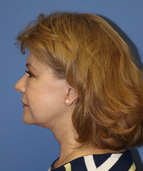 Facelift #6486 – click HERE for more views after photo. Individual results may vary.