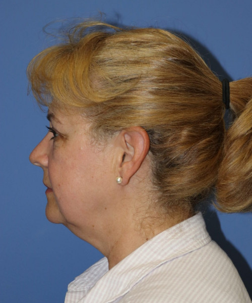 Facelift #6486 – click HERE for more views before photo. Individual results may vary.
