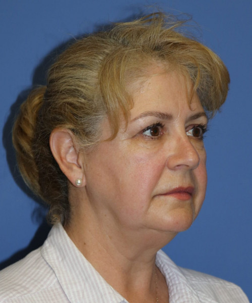 Facelift #6486 – click HERE for more views before photo. Individual results may vary.