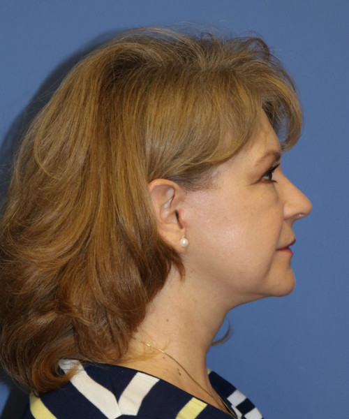 Facelift #6486 – click HERE for more views after photo. Individual results may vary.