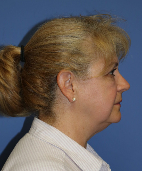 Facelift #6486 – click HERE for more views before photo. Individual results may vary.