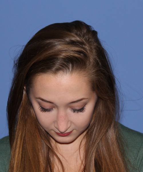 Rhinoplasty, Chin Augmentation 0649 – Click HERE for more views after photo. Individual results may vary.