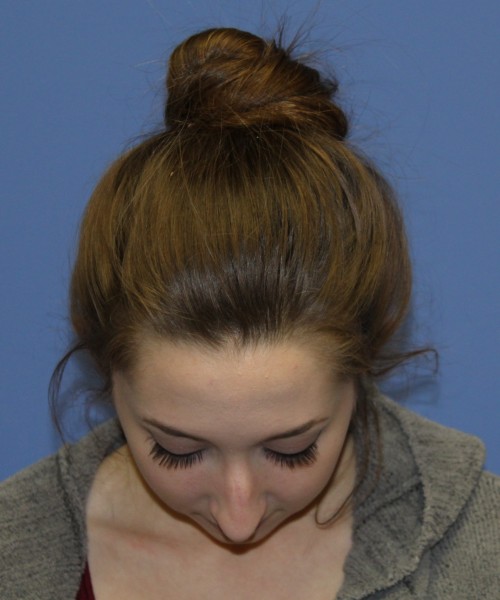 Rhinoplasty, Chin Augmentation 0649 – Click HERE for more views before photo. Individual results may vary.