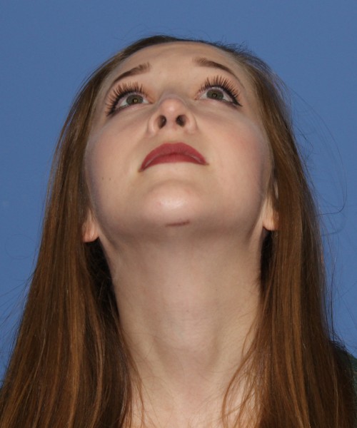 Rhinoplasty, Chin Augmentation 0649 – Click HERE for more views after photo. Individual results may vary.