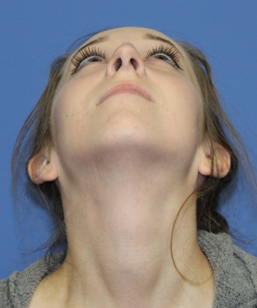 Rhinoplasty, Chin Augmentation 0649 – Click HERE for more views before photo. Individual results may vary.
