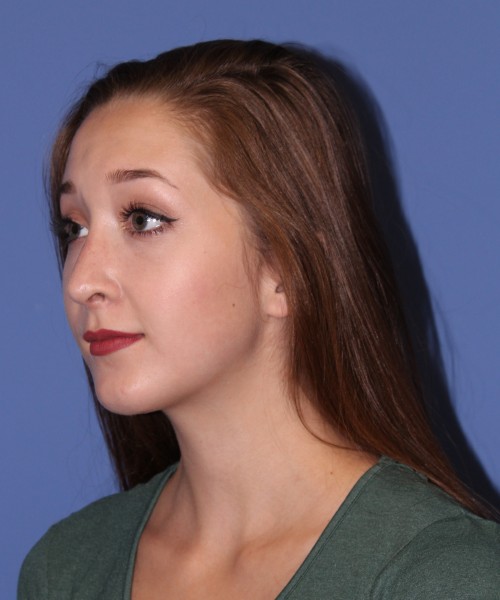 Rhinoplasty, Chin Augmentation 0649 – Click HERE for more views after photo. Individual results may vary.