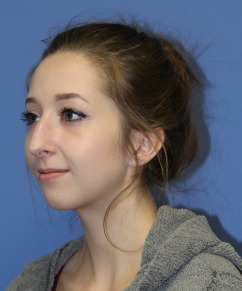 Rhinoplasty, Chin Augmentation 0649 – Click HERE for more views before photo. Individual results may vary.