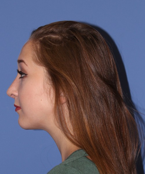Rhinoplasty, Chin Augmentation 0649 – Click HERE for more views after photo. Individual results may vary.
