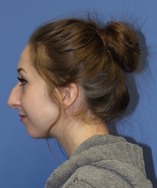 Rhinoplasty, Chin Augmentation 0649 – Click HERE for more views before photo. Individual results may vary.