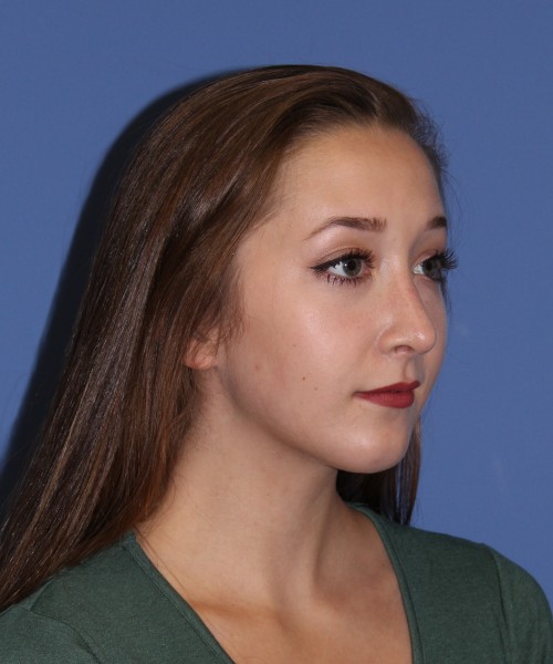 Rhinoplasty, Chin Augmentation 0649 – Click HERE for more views after photo. Individual results may vary.