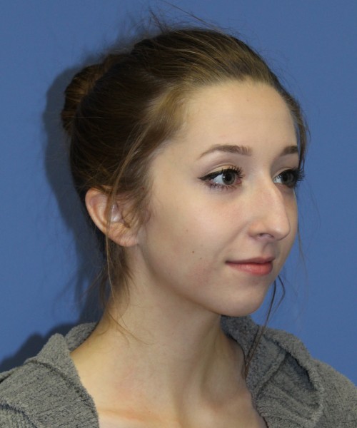 Rhinoplasty, Chin Augmentation 0649 – Click HERE for more views before photo. Individual results may vary.