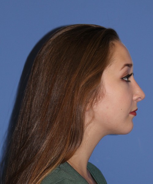 Rhinoplasty, Chin Augmentation 0649 – Click HERE for more views after photo. Individual results may vary.