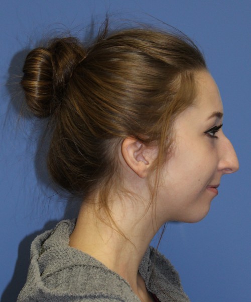 Rhinoplasty, Chin Augmentation 0649 – Click HERE for more views before photo. Individual results may vary.