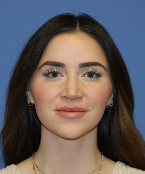 Rhinoplasty #6497 – click HERE for more views after photo. Individual results may vary.