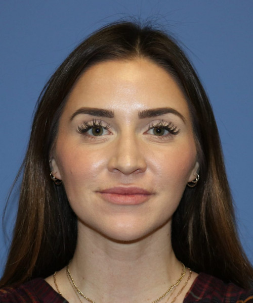 Rhinoplasty #6497 – click HERE for more views before photo. Individual results may vary.