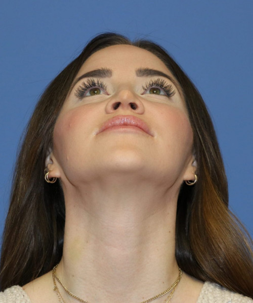 Rhinoplasty #6497 – click HERE for more views after photo. Individual results may vary.