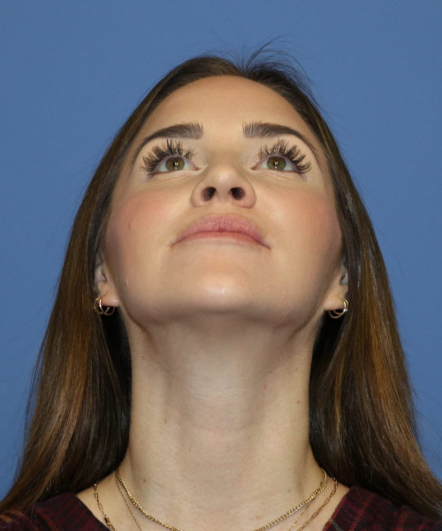 Rhinoplasty #6497 – click HERE for more views before photo. Individual results may vary.