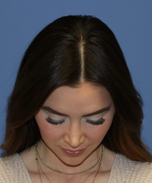 Rhinoplasty #6497 – click HERE for more views after photo. Individual results may vary.