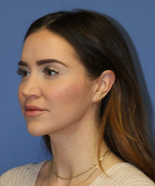 Rhinoplasty #6497 – click HERE for more views after photo. Individual results may vary.