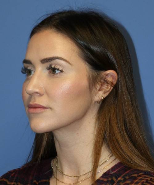 Rhinoplasty #6497 – click HERE for more views before photo. Individual results may vary.