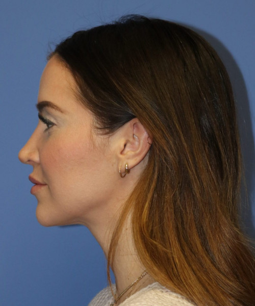 Rhinoplasty #6497 – click HERE for more views after photo. Individual results may vary.