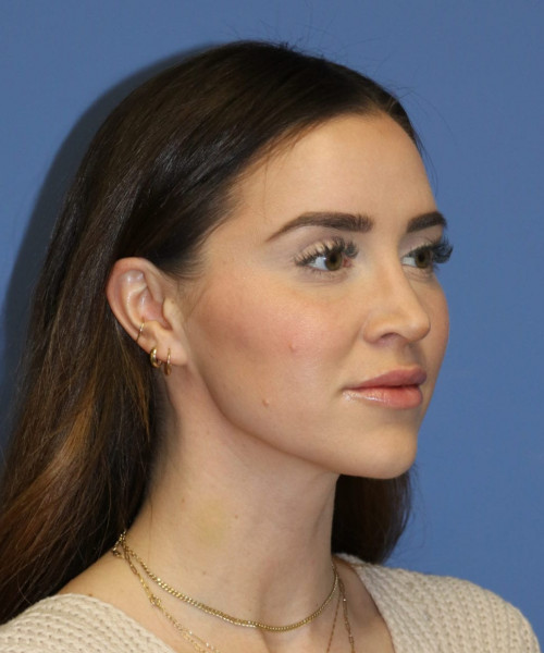 Rhinoplasty #6497 – click HERE for more views after photo. Individual results may vary.