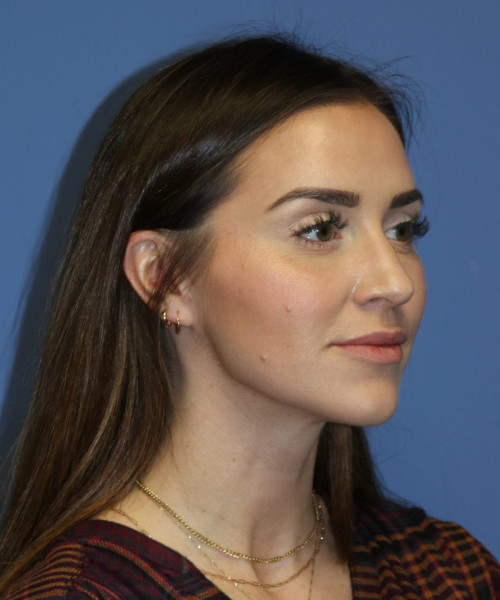 Rhinoplasty #6497 – click HERE for more views before photo. Individual results may vary.