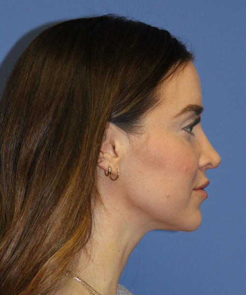 Rhinoplasty #6497 – click HERE for more views after photo. Individual results may vary.