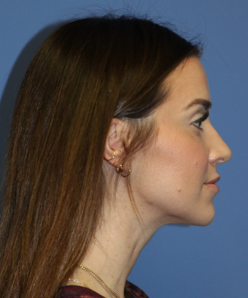 Rhinoplasty #6497 – click HERE for more views before photo. Individual results may vary.