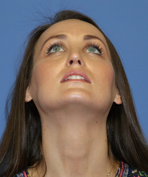 Rhinoplasty #6562 – click HERE for more views after photo. Individual results may vary.