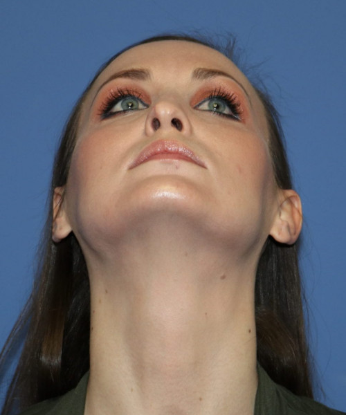 Rhinoplasty #6562 – click HERE for more views before photo. Individual results may vary.