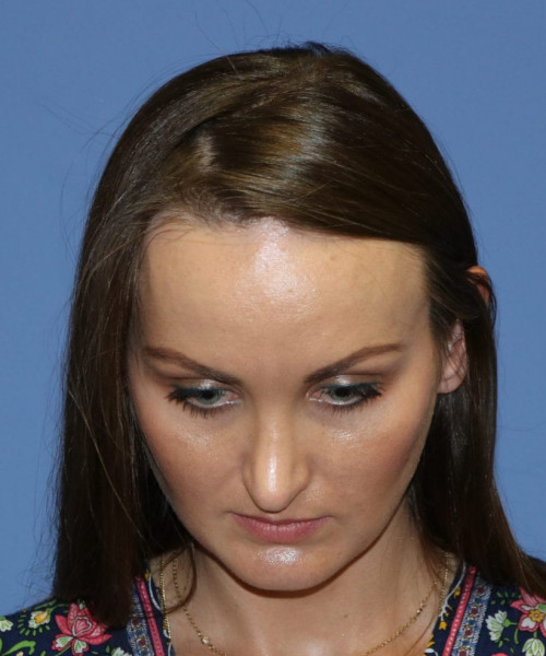 Rhinoplasty #6562 – click HERE for more views after photo. Individual results may vary.